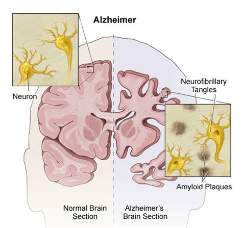 Alzheimer’s disease brain