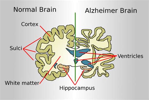 Alzheimer’s Disease normal brain and Alzheimer’s Disease brain