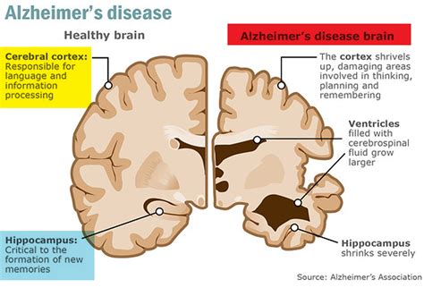 Alzheimer’s Disease Shocking Facts
